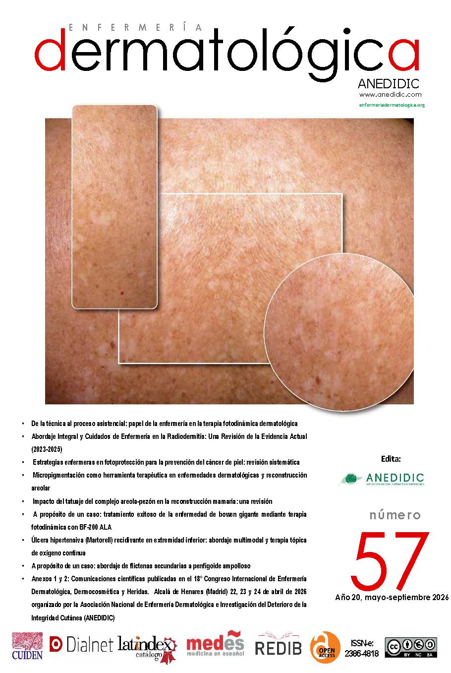 					Ver Vol. 20 Núm. 57 (2026): ENFERMERÍA DERMATOLÓGICA
				
